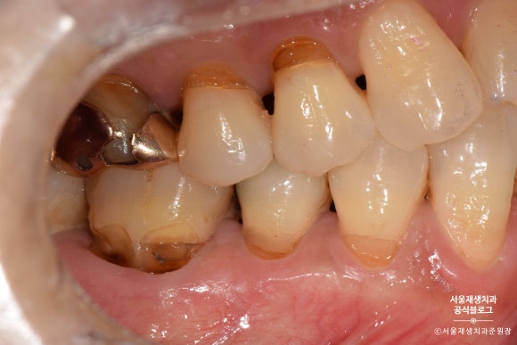 잇몸 패임, 무슨 재료로 때우나요? 레진과 글라스아이오노머(GI)로 치경부마모증 치료하기 (서울재생치과,신촌치과) 관련 이미지 8