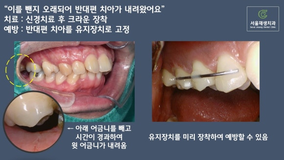 치과에서 치료하는 치아가 아닌 반대편 치아를 갈아내는 이유는? 장기 치료에 반드시 필요한 "정출방지 치아고정"에 대해 알아봅시다. 관련 이미지 13