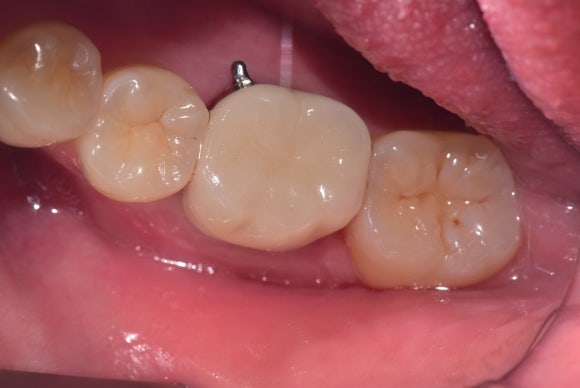 [재신경치료] 20대 남성, 9년 전에 신경치료한 치아에서 고름이 나와요. 관련 이미지 10