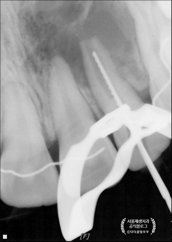 [재생근관치료] 이가 난지 얼마 안 됐는데 신경이 죽었대요...(소아 치아 외상, 치수 괴사, 미성숙 영구치, 신경재생술, REP, 치료기간, MTA 신경치료, 내원횟수) 관련 이미지 7
