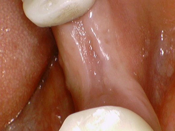 [임플란트] 재신경치료를 시도할 수 없을 때. 뼈이식 없는 임플란트 시술로 간편하게. 관련 이미지 7