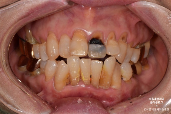잇몸 패임, 무슨 재료로 때우나요? 레진과 글라스아이오노머(GI)로 치경부마모증 치료하기 (서울재생치과,신촌치과) 관련 이미지 10