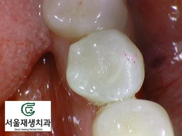 [치외치신경치료] 뿌리 끝 염증이 커서 발치해야된대요! 치아 머리에 볼~록! 알고보면 무서운 작은 혹 (서울재생치과) 관련 이미지 23