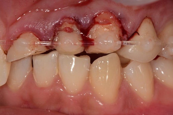 [치아외상] 부러진 앞니, 발치가 답인가요? (사고로 부러진 치아, 외과적정출술로 살리기) 관련 이미지 19