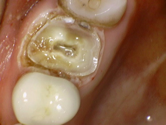 [치아살리기] 부러진 치아를 빼고 임플란트해야 한대요. 관련 이미지 5