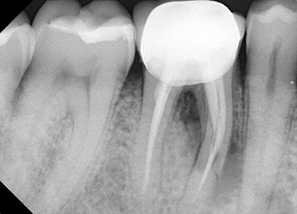 [치아절제술/hemisection] 뿌리가 부러진 소중한 내 어금니..이대로 뽑긴 아까워요. 관련 이미지 3