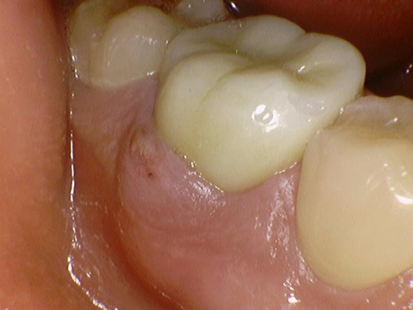 [재신경치료] 6개월 전에 신경치료한 치아에서 고름이 나와요. 관련 이미지 5