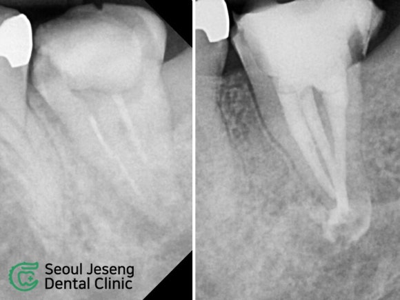 [치료사례] 재신경치료 (3) 관련 이미지 1
