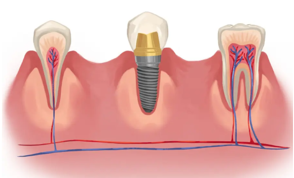 [턱관절] 임플란트 맞은 편 치아가 아파요! (외상성교합, 강한 교합력, 보톡스 치료,턱관절물리치료, 치과 보험진료) 관련 이미지 8