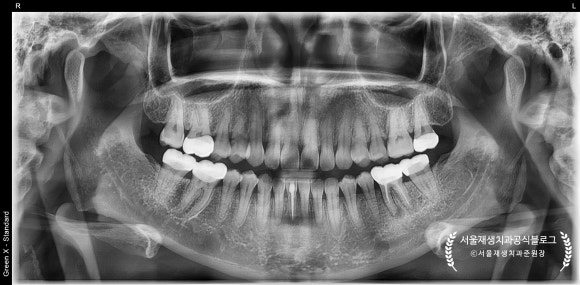 [재신경치료] 예전에 신경치료 받은 치아가 갑자기 붓고 아파요! (현미경을 통해 정확하고 섬세하게 재신경치료 하기) 관련 이미지 21