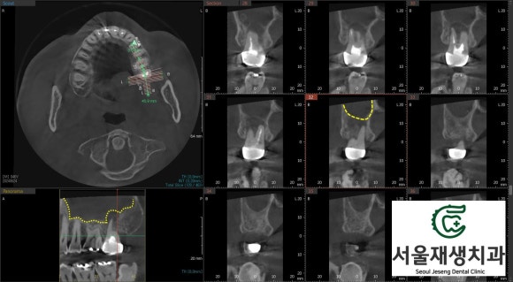 [재신경치료] 40대 남성, 윗 어금니 신경치료 후 상악동까지 염증이 전파된 사례 (서울재생치과 미세현미경치료) 관련 이미지 5