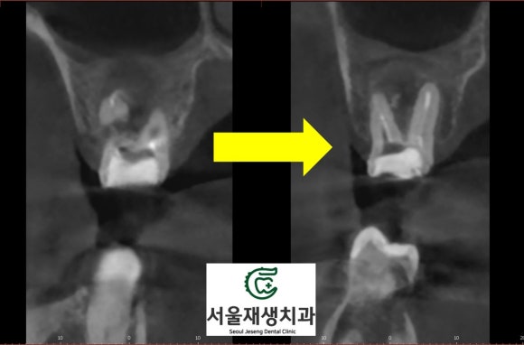 [재신경치료] 타치과에서 재신경치료 하는 중인데 발치를 하자고 했어요... (서울재생치과 현미경 신경치료) 관련 이미지 9