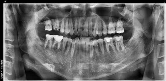 [재신경치료] 다른 치과에서 재신경치료했는데 여전히 불편해요. 40대 남성 환자분의 재재신경치료 이야기. 관련 이미지 3