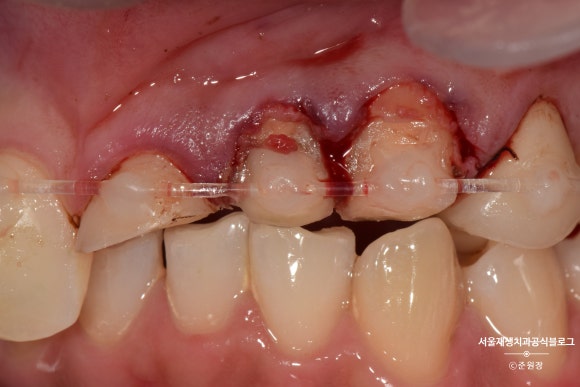 [치아외상] 부러진 앞니, 발치가 답인가요? (사고로 부러진 치아, 외과적정출술로 살리기) 관련 이미지 18