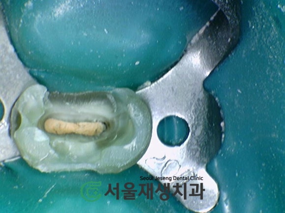 [재신경치료] 다른 치과에서 빼라고 했는데...혹시 살릴 수는 없을까요? (현미경 신경치료, 서울재생치과) 관련 이미지 8