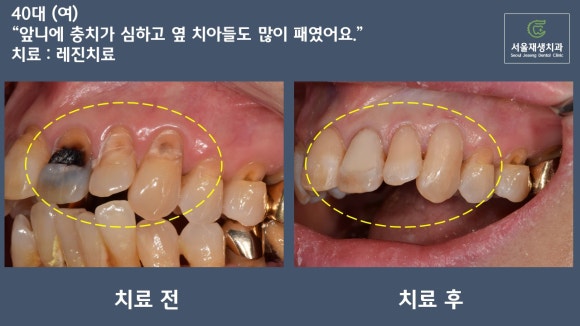 [치료사례] 잇몸 패임 때문에 음식이 많이끼고 충치가 생겨요. 관련 이미지 5