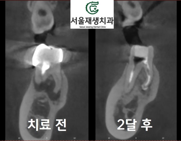 [재신경치료] 신경치료 받은 치아가 붓고 아파요! 현미경과 CT의 도움으로 다시 한 번 꼼꼼하게~ 관련 이미지 16