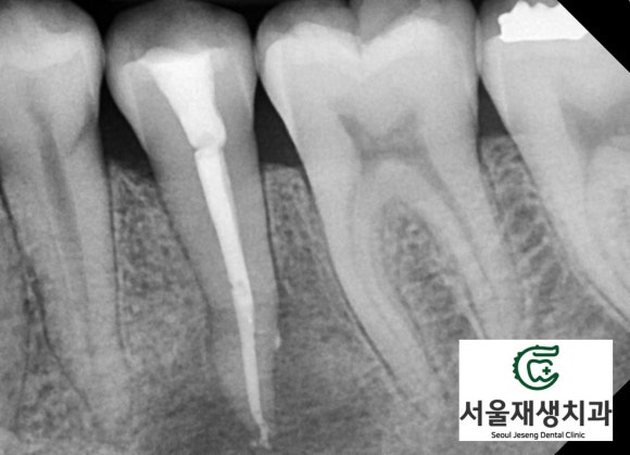[치외치신경치료] 뿌리 끝 염증이 커서 발치해야된대요! 치아 머리에 볼~록! 알고보면 무서운 작은 혹 (서울재생치과) 관련 이미지 22