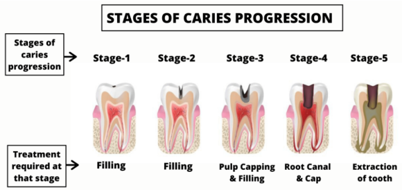 충치나 파절로 짧아진 치아도 다시 보자! (의도적 재식술/치아정출술 후 브릿지치료) 관련 이미지 2