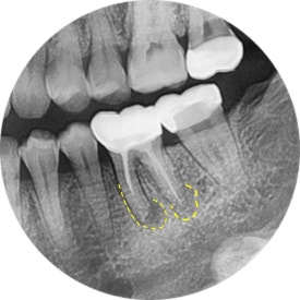 [재신경치료] 예전에 신경치료 받은 치아가 갑자기 붓고 아파요! (현미경을 통해 정확하고 섬세하게 재신경치료 하기) 관련 이미지 23