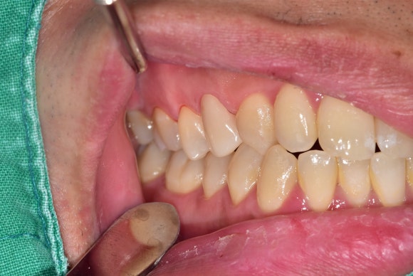 [신경치료] 충치가 커서 뿌리만 남았대요. 비발치 신경치료로 자연치아 살리기! 관련 이미지 11