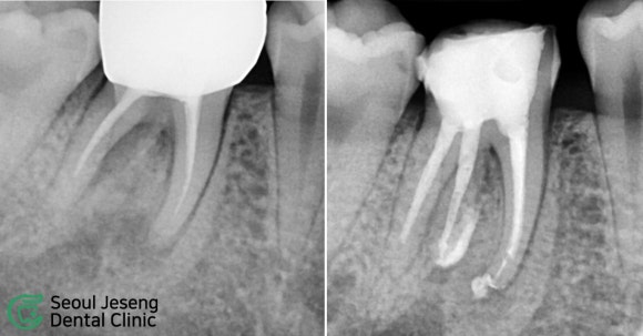 [치료사례] 재신경치료 (2) 관련 이미지 1