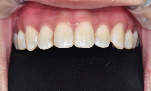 치과에서 미백치료를 받은 후에 치아에 하얀 반점이 생기고 얼룩덜룩해졌어요. 관련 이미지 3