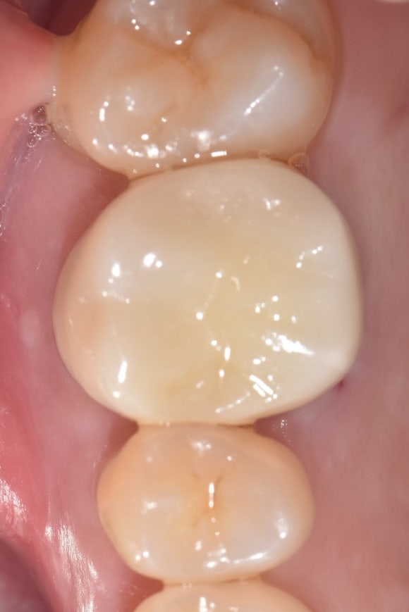 [재신경치료] 10년전에 한 신경치료가 뭔가 불편해요... 관련 이미지 7
