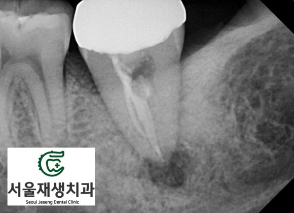 [재신경치료] 치과 종사자도 찾아오는 신경치료 전문치과, 서울재생치과! 관련 이미지 4