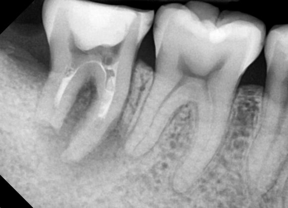 [고난이도 신경치료] 사랑니 때문에 뿌리가 흡수되어 버린 치아...살릴 수 있나요? 관련 이미지 6