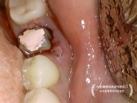 [재신경치료] 예전에 신경치료 받은 치아가 갑자기 붓고 아파요! (현미경을 통해 정확하고 섬세하게 재신경치료 하기) 관련 이미지 30