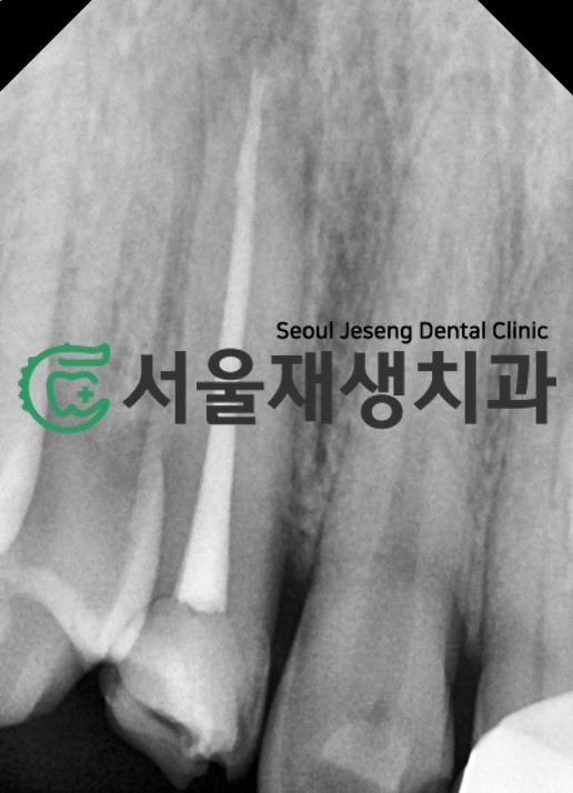 [치아정출술] 충치가 뿌리까지 진행되서 발치해야 한대요...뿌리 깊은 충치도 살려내기 (서울재생치과) 관련 이미지 9