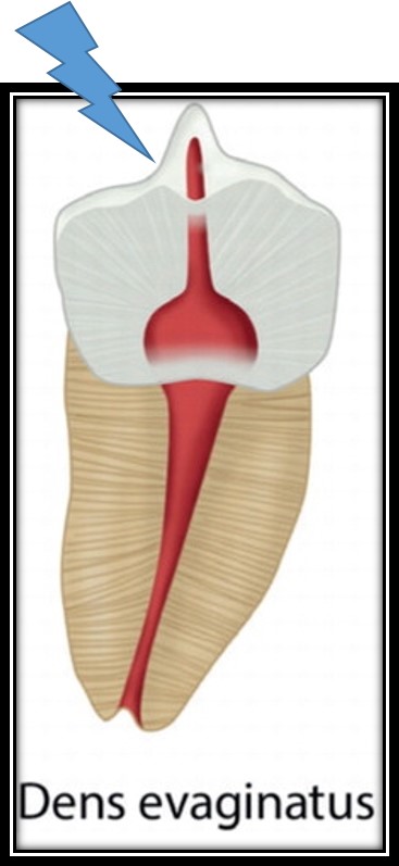 [치외치신경치료] 뿌리 끝 염증이 커서 발치해야된대요! 치아 머리에 볼~록! 알고보면 무서운 작은 혹 (서울재생치과) 관련 이미지 8
