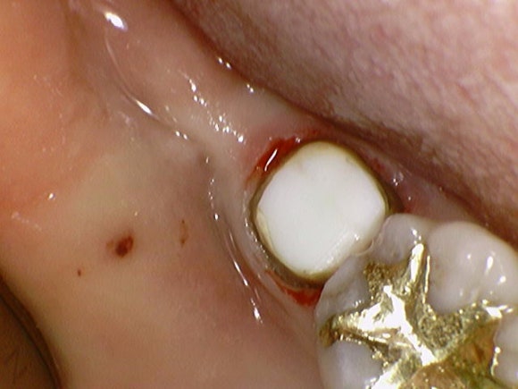 [재신경치료] 잇몸이 부었어요. 다니던 치과에서는 재신경치료 하거나 발치하라고 했어요. 관련 이미지 9