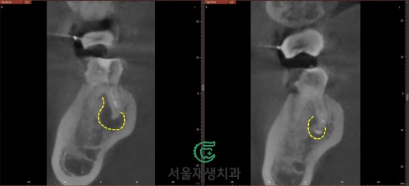 [재신경치료] 3년 전에 신경치료 했던 치아인데 다시 아파요! (미세 현미경 재신경치료, 서울재생치과) 관련 이미지 10