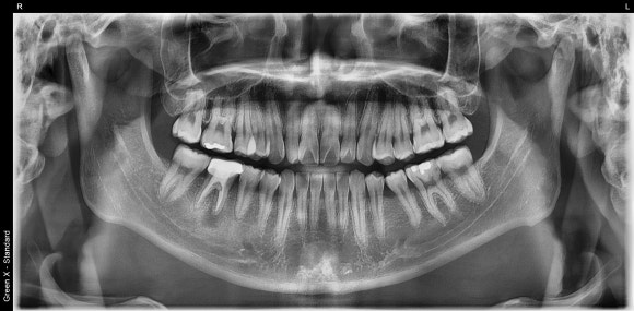 [재신경치료] 20대 남성, 9년 전에 신경치료한 치아에서 고름이 나와요. 관련 이미지 3