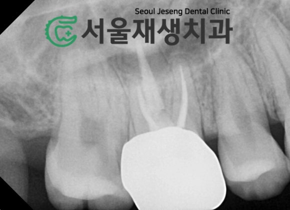 [MTA충치치료] 충치가 클 때.. 신경치료 안하고 치료하는 법 (치수복조술, 신촌 서울재생치과) 관련 이미지 5