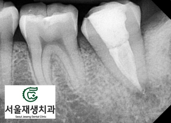 [재신경치료] 치과 종사자도 찾아오는 신경치료 전문치과, 서울재생치과! 관련 이미지 10