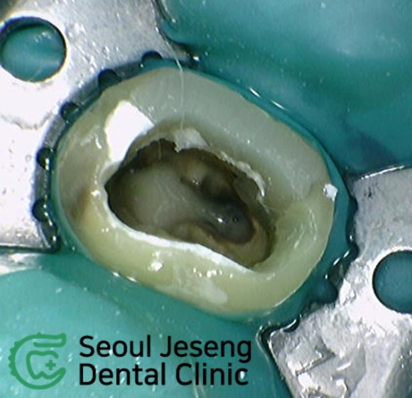 [재신경치료] 재신경치료까지 했는데 계속 아파요..미세 현미경을 이용한 세번째 신경치료! (서울재생치과) 관련 이미지 6