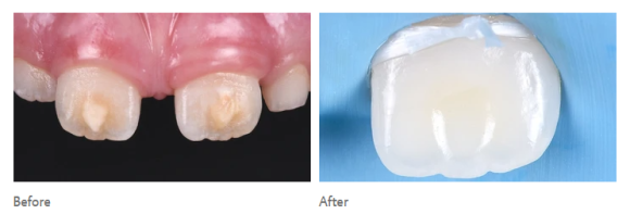 얼룩덜룩한 흰반점, white spot을 치료하는 법 (무삭제 충치치료) 관련 이미지 7