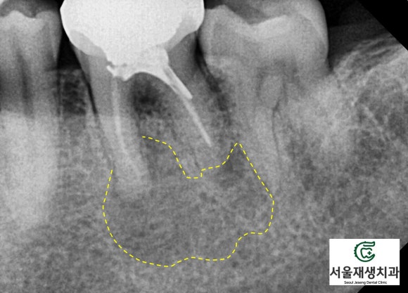 재신경치료의 치료 기간, 내원 횟수, 간격 (신촌치과, 서울재생치과, 서울대 보존과 전문의) 관련 이미지 7