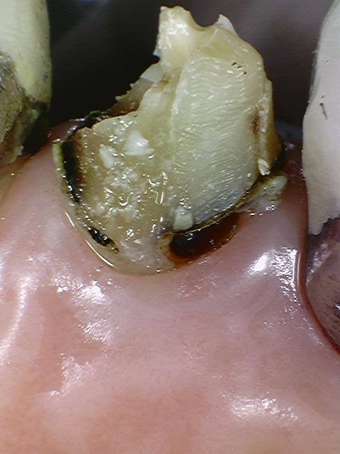 크라운 다음은 임플란트인가요...? (크라운 밑으로 생긴 충치, 크라운 다음엔 어떤 치료를...?, 자연치아 살리는 치과, 서울재생치과) 관련 이미지 5