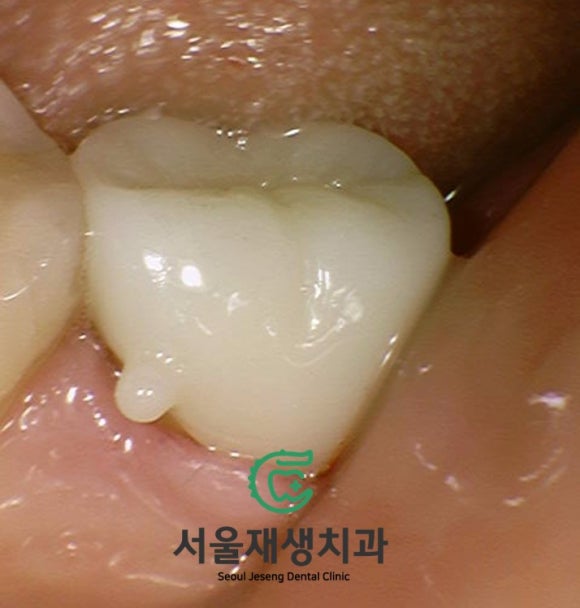 치아 뿌리에 생긴 충치...살릴 수 있는 방법 없을까요? 현미경을 이용하여 보다 꼼꼼하게! 관련 이미지 7