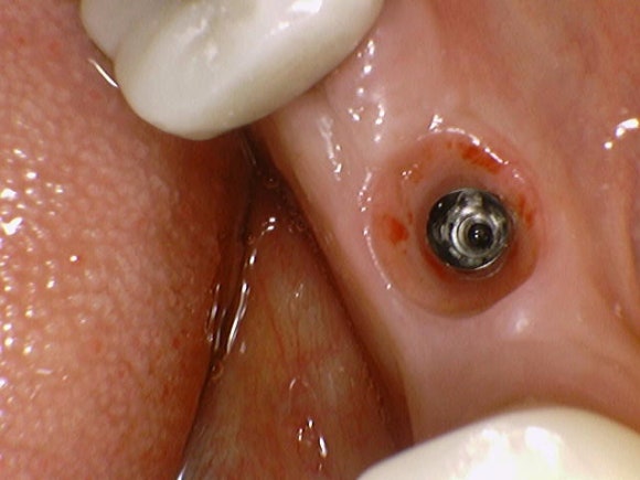 [임플란트] 재신경치료를 시도할 수 없을 때. 뼈이식 없는 임플란트 시술로 간편하게. 관련 이미지 12