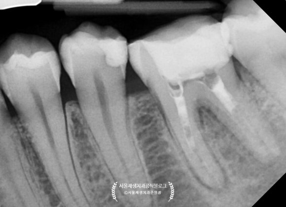 [재신경치료] 예전에 신경치료 받은 치아가 갑자기 붓고 아파요! (현미경을 통해 정확하고 섬세하게 재신경치료 하기) 관련 이미지 18
