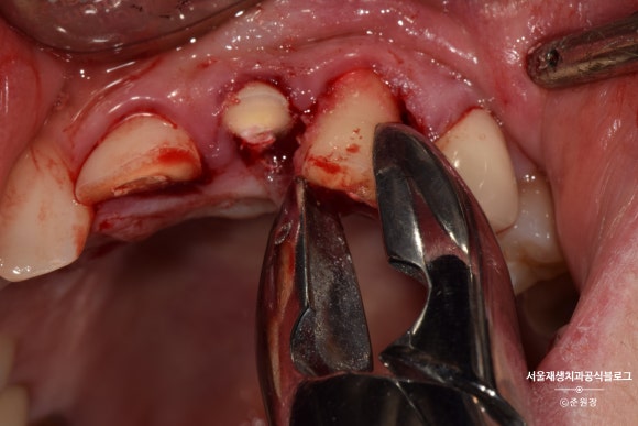 [치아외상] 부러진 앞니, 발치가 답인가요? (사고로 부러진 치아, 외과적정출술로 살리기) 관련 이미지 6