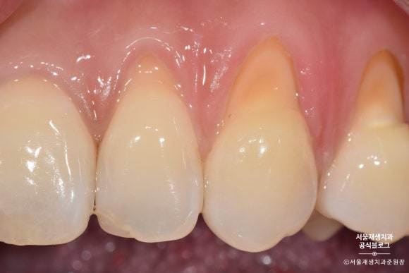 잇몸 패임, 무슨 재료로 때우나요? 레진과 글라스아이오노머(GI)로 치경부마모증 치료하기 (서울재생치과,신촌치과) 관련 이미지 7