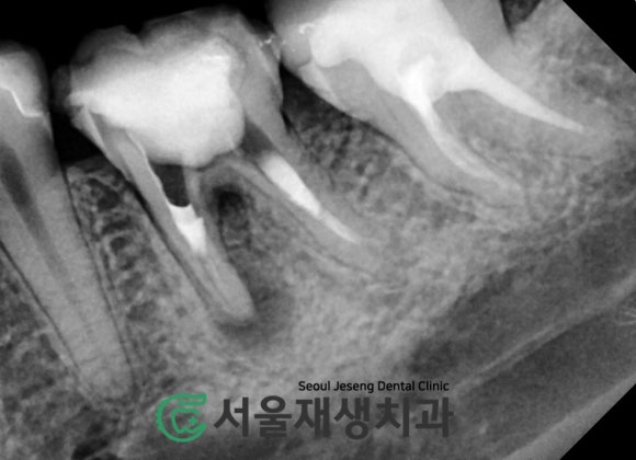 [재신경치료] 예전에 신경치료 받은 치아....치근단 절제술이나 발치를 해야 한다는데요?! (신촌 서울재생치과) 관련 이미지 9