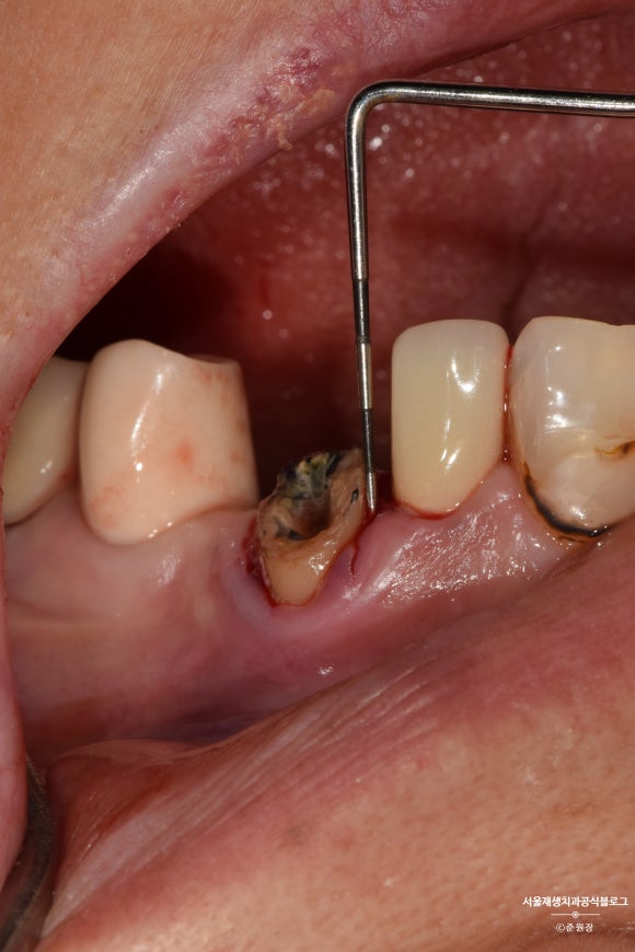 충치나 파절로 짧아진 치아도 다시 보자! (의도적 재식술/치아정출술 후 브릿지치료) 관련 이미지 6