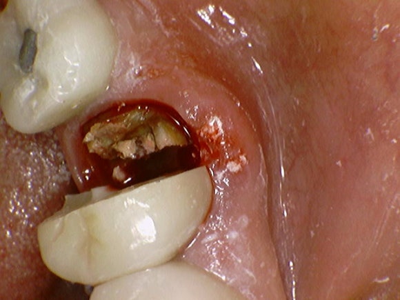 [임플란트] 재신경치료를 시도할 수 없을 때. 뼈이식 없는 임플란트 시술로 간편하게. 관련 이미지 5